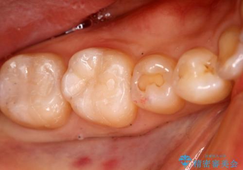 奥歯を綺麗にしたい