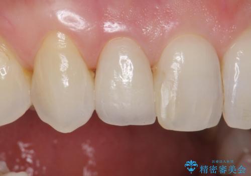 前歯が取れてしまった ジルコニアクラウンでの修復の治療中