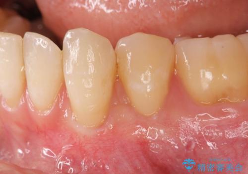 [ 歯ぐきのさがり ]   歯肉退縮に対して行う結合組織移植術の治療後