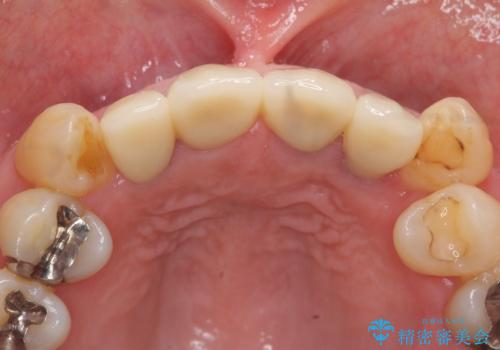 前歯の見た目をオールセラミッククラウンで改善の治療後