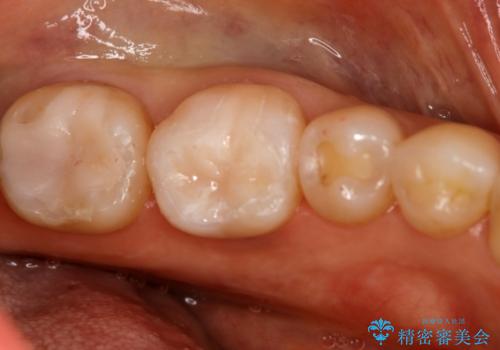 下の奥歯の銀歯を白くしたい