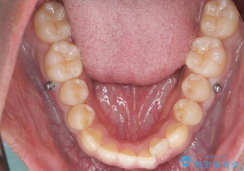 骨格性の受け口の矯正 部分ワイヤーで上の前歯を前に、 マウスピースで下の前歯を後ろに。の治療中