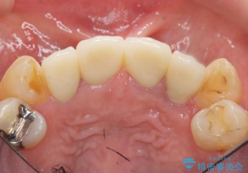 前歯の見た目をオールセラミッククラウンで改善の治療後