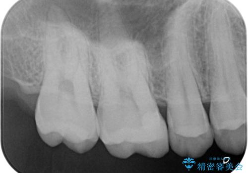 銀歯を白くしたい。の治療後