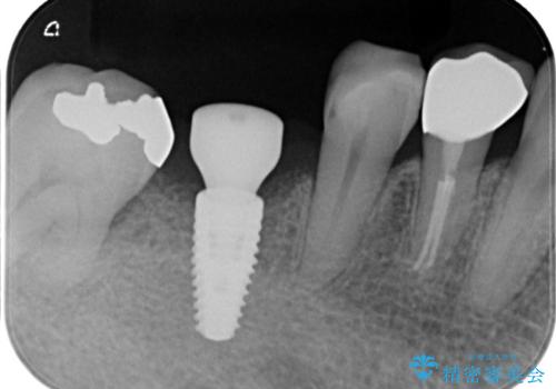 奥歯で食事をしたい インプラントとノンクラスプデンチャーによる治療の治療中