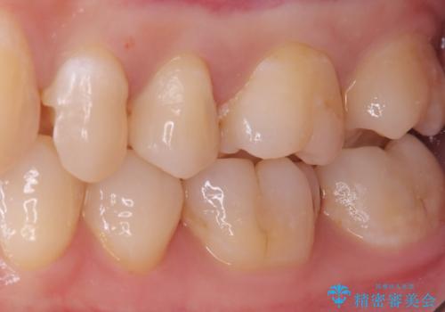 【セラミックインレー】歯が欠けたので治したいの治療中