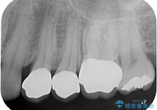 【オールセラミッククラウン】虫歯治療!再治療を減らす治療!の治療後