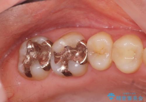 メタルフリー治療　銀歯を全て除去したいの症例 治療前