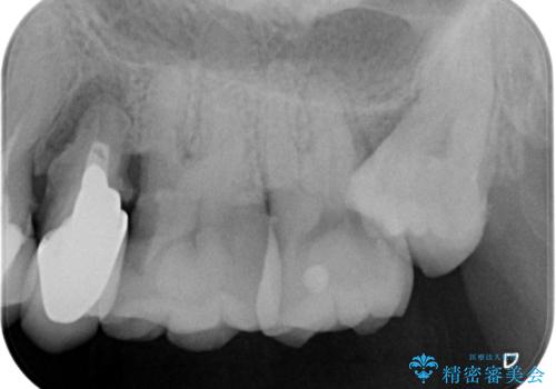 重度歯周病 抜歯後のブリッジ治療の治療前