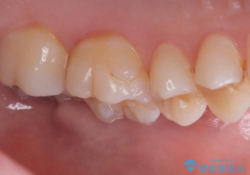 【セラミックインレー】歯が欠けたので治したいの治療前