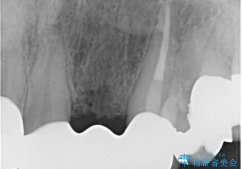 前歯が気になる。ブリッジによる治療。の治療後