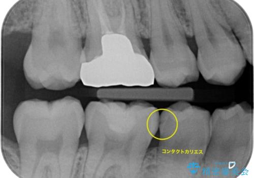 他院で虫歯を指摘された。自費治療希望。の治療前