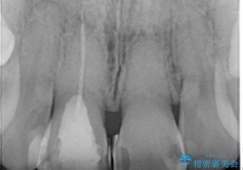 リアルな歯の色調にこだわるオールセラミッククラウン治療の治療前