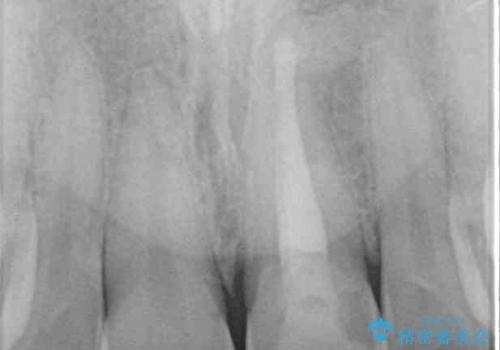 ぶつけて変色した前歯 オールセラミッククラウン治療の治療前