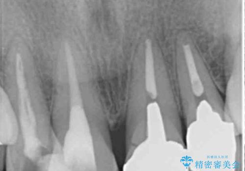 前歯の見た目をオールセラミッククラウンで改善の治療前