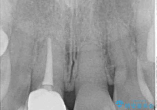 リアルな歯の色調にこだわるオールセラミッククラウン治療の治療後