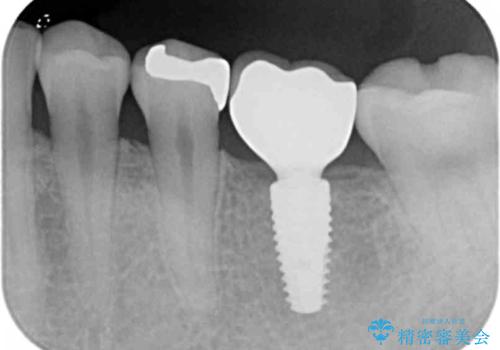 虫歯の再発による抜歯後のインプラント治療の治療後
