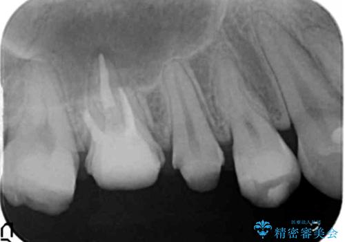 歯周外科を行い歯ぐきの整備を行うセラミック治療の治療中