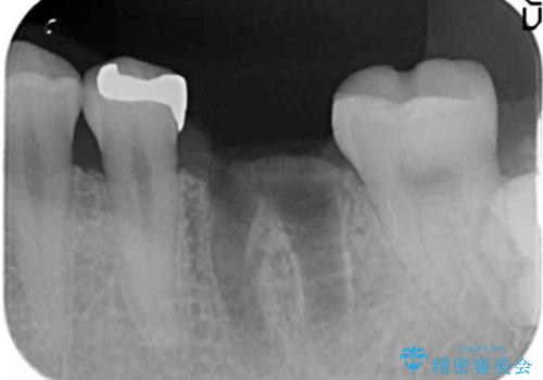 虫歯の再発による抜歯後のインプラント治療の治療前