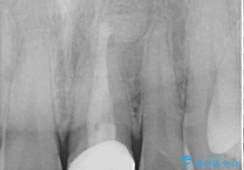 ぶつけて変色した前歯 オールセラミッククラウン治療の治療後
