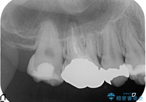 歯周外科を行い歯ぐきの整備を行うセラミック治療の治療前