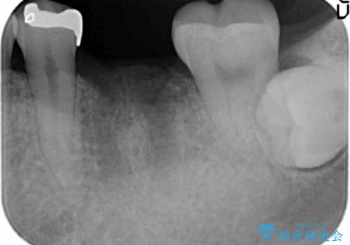 虫歯の再発による抜歯後のインプラント治療の治療中