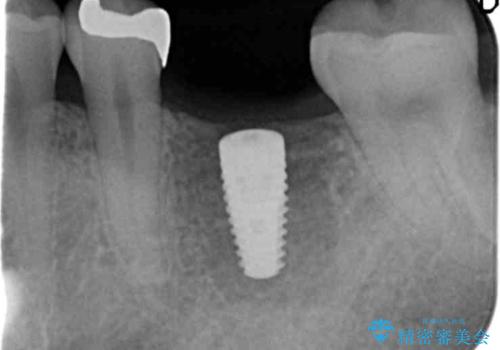 虫歯の再発による抜歯後のインプラント治療の治療中