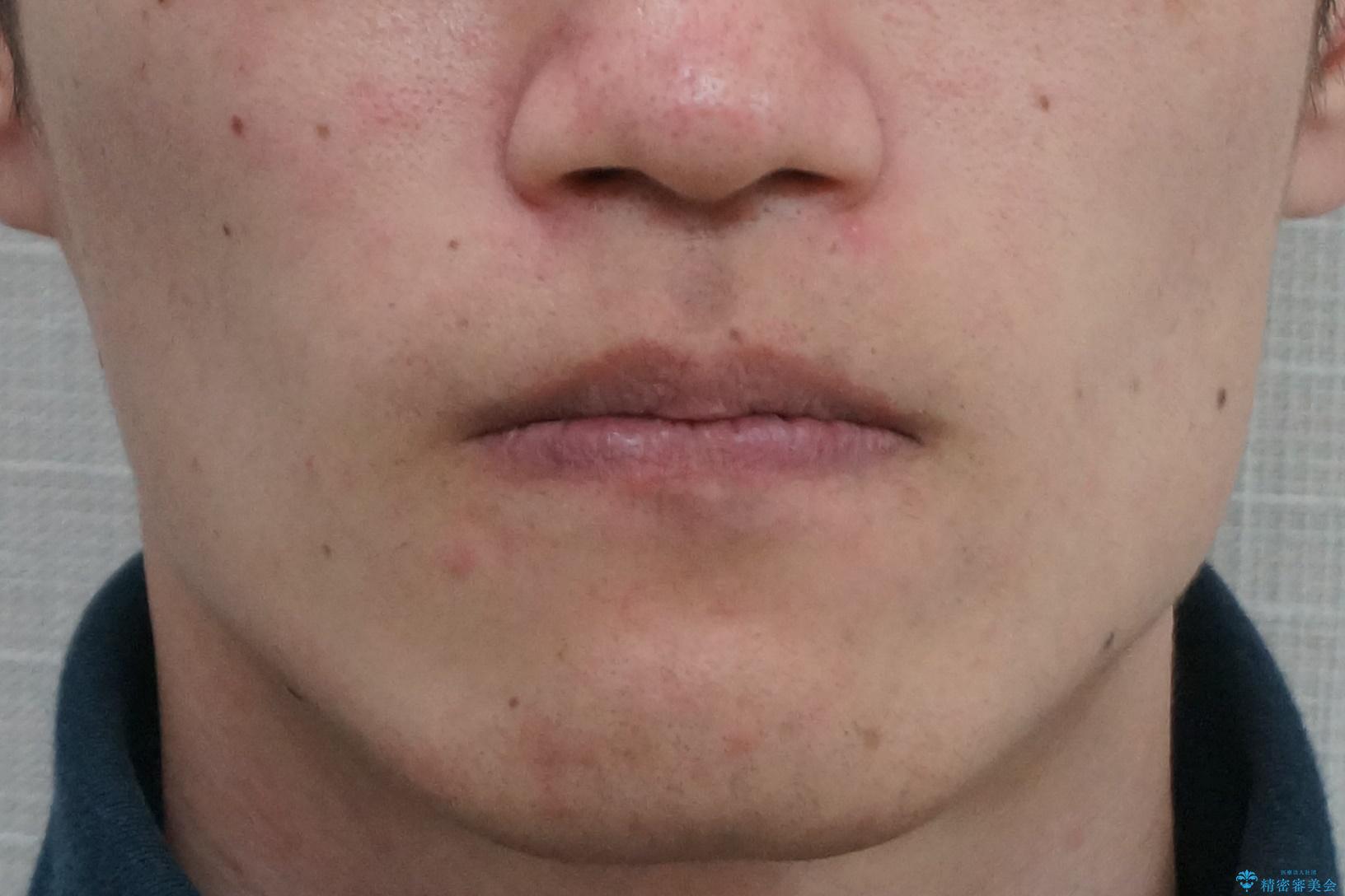 骨格性の受け口の矯正 部分ワイヤーで上の前歯を前に、 マウスピースで下の前歯を後ろに。の治療後(顔貌)