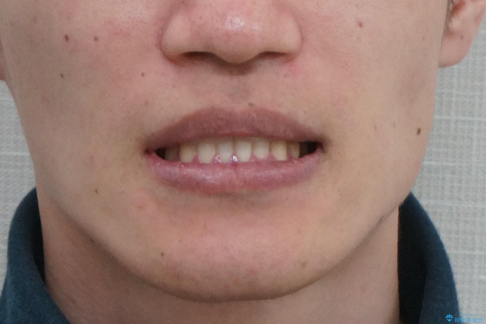 骨格性の受け口の矯正 部分ワイヤーで上の前歯を前に、 マウスピースで下の前歯を後ろに。の治療後(顔貌)