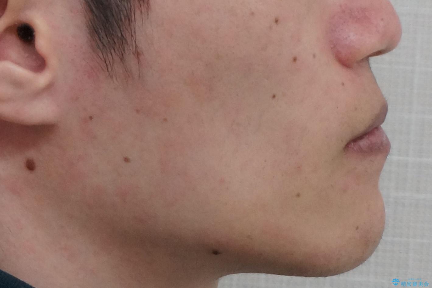 骨格性の受け口の矯正 部分ワイヤーで上の前歯を前に、 マウスピースで下の前歯を後ろに。の治療後(顔貌)