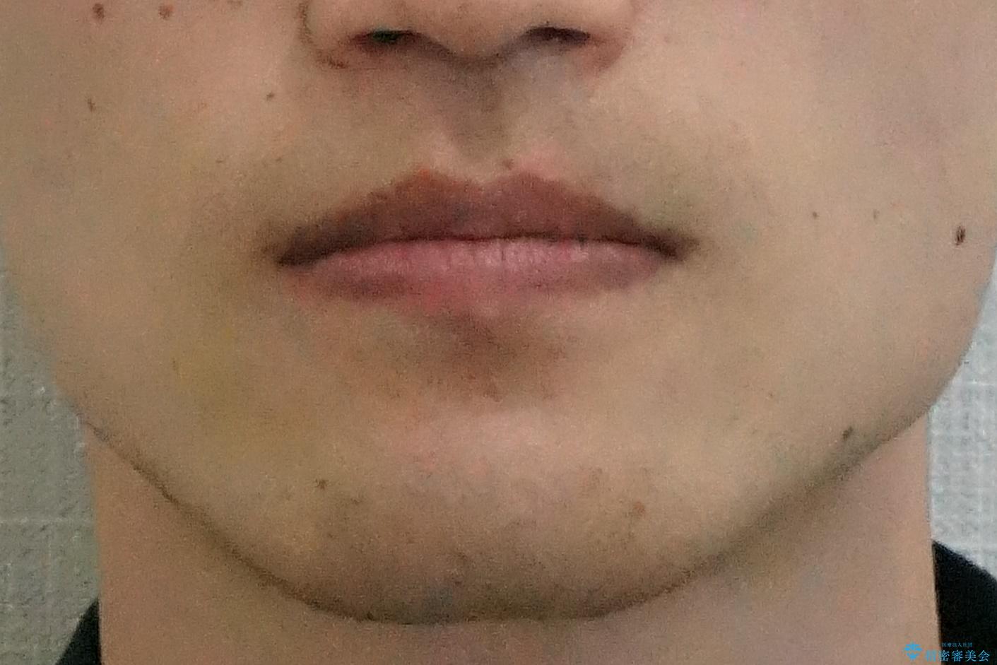 骨格性の受け口の矯正 部分ワイヤーで上の前歯を前に、 マウスピースで下の前歯を後ろに。の治療前(顔貌)