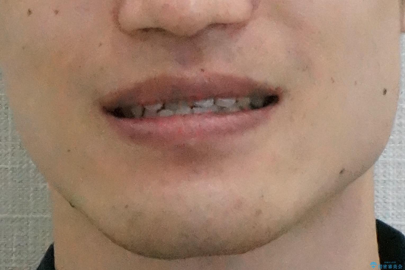 骨格性の受け口の矯正 部分ワイヤーで上の前歯を前に、 マウスピースで下の前歯を後ろに。の治療前(顔貌)