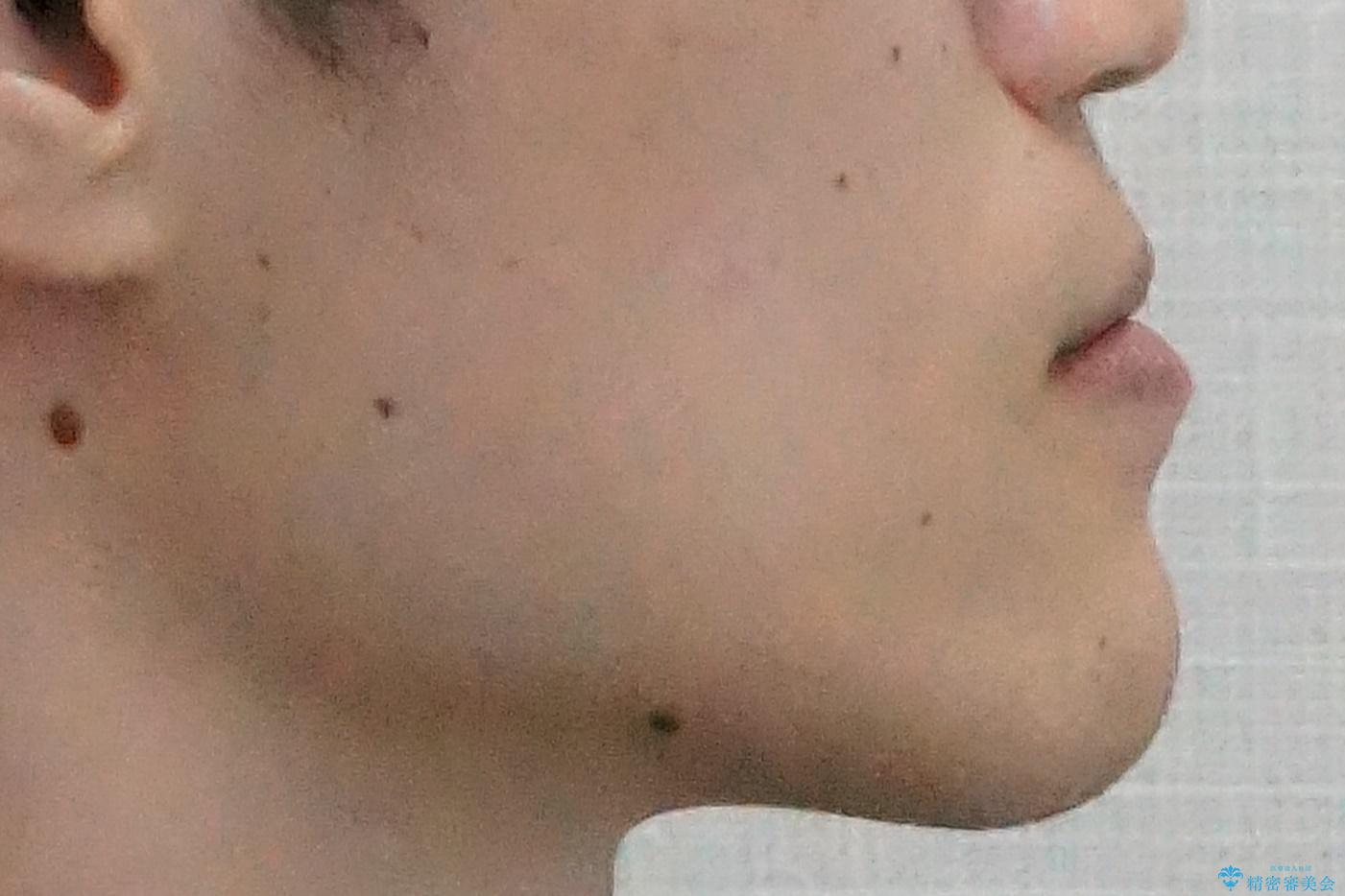 骨格性の受け口の矯正 部分ワイヤーで上の前歯を前に、 マウスピースで下の前歯を後ろに。の治療前(顔貌)