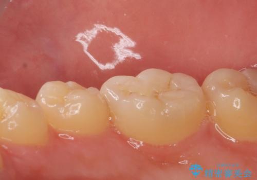 他院で虫歯を指摘された。自費治療希望。の治療前