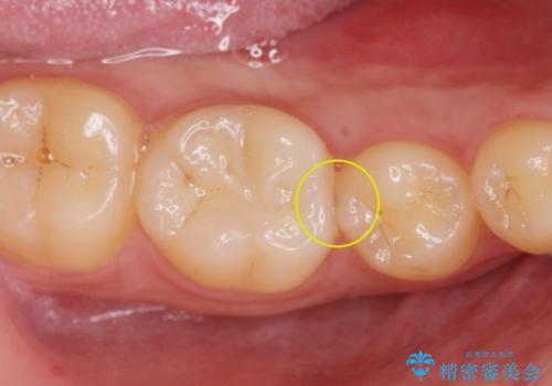 他院で虫歯を指摘された。自費治療希望。の治療前