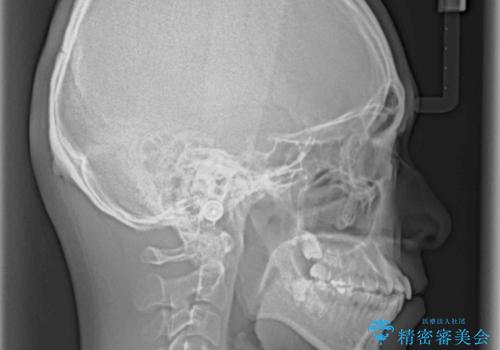 顎が左右にずれた咬み合わせ ハーフリンガルの抜歯矯正の治療前