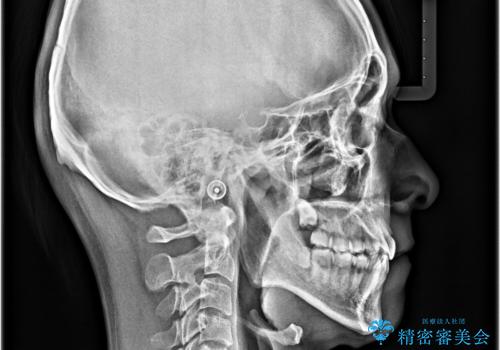 顎が左右にずれた咬み合わせ ハーフリンガルの抜歯矯正の治療後