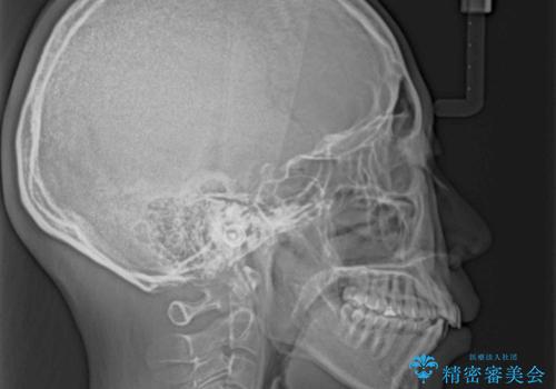 【モニター】飛び出した上顎前歯を抜歯矯正で引っ込める ワイヤー装置の抜歯矯正治療の治療前