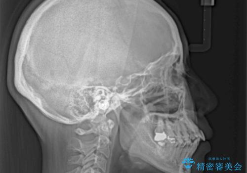 前方に飛び出した前歯 ワイヤー装置での抜歯矯正の治療前
