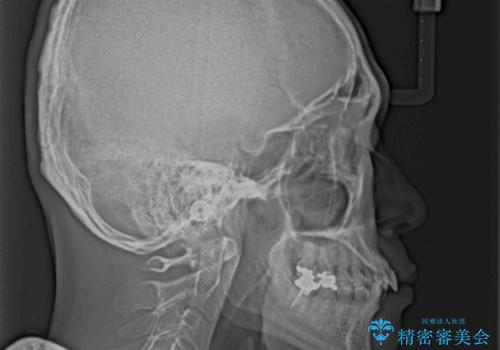 【モニター】口が閉じにくい　抜歯矯正でスッキリした口元にの治療前