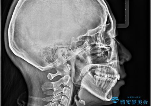 【モニター】飛び出した上顎前歯を抜歯矯正で引っ込める ワイヤー装置の抜歯矯正治療の治療後
