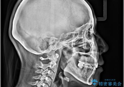 前方に飛び出した前歯 ワイヤー装置での抜歯矯正の治療後
