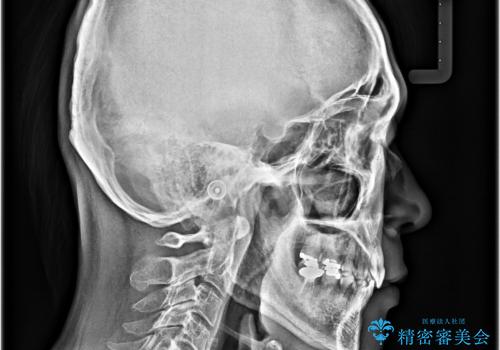 【モニター】口が閉じにくい 抜歯矯正でスッキリした口元にの治療後