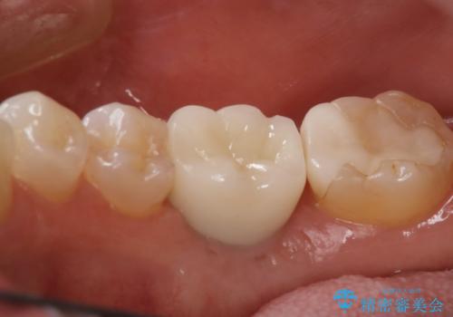 『インプラント』主訴:歯を入れたいの治療後