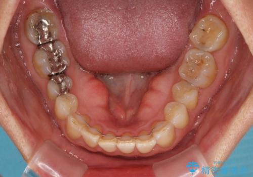 インビザラインが続けられない 忍耐のマウスピース矯正の治療後
