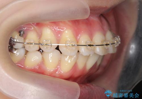 捻れた奥歯 突き出た前歯を治したいの治療中