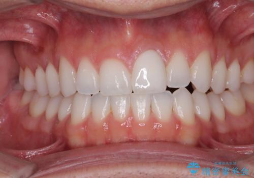 ぶつけて変色した前歯　オールセラミッククラウン治療の治療後