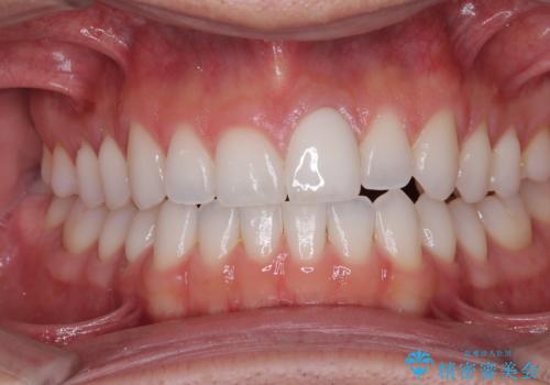 ぶつけて変色した前歯 オールセラミッククラウン治療の治療後