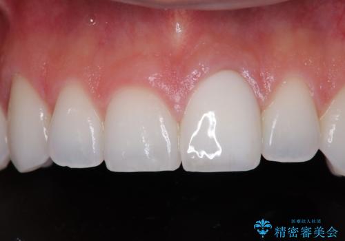 ぶつけて変色した前歯 オールセラミッククラウン治療の症例 治療後