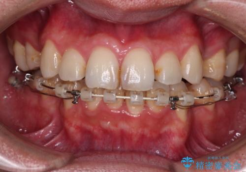 顎が左右にずれた咬み合わせ ハーフリンガルの抜歯矯正の治療中